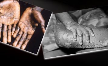 Possibilities of Monkeypox finding its foothold in Maldives